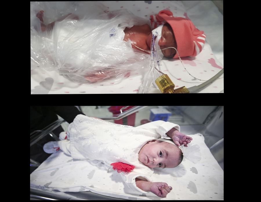 460 gram doğan bebek 137 günlük mücadeleyle yaşama tutundu