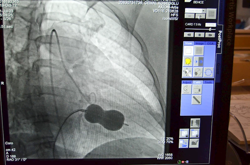 Kalp kapağı hastası ameliyatsız yöntemle sağlığına kavuştu