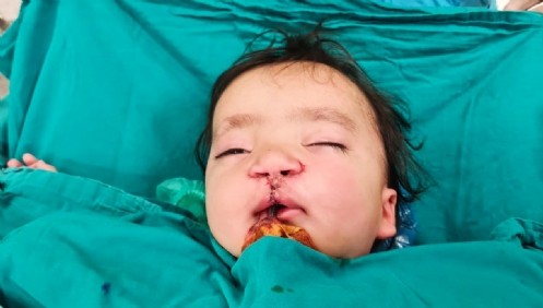 Doğuştan Dudak-Damak Yarığı Olan 9 Aylık Bebek, KSÜ Tıp`ta Sağlığına Kavuştu
